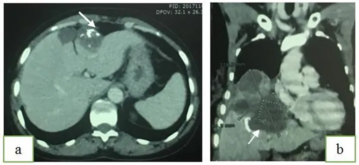 Diaphragmatic Hydatid Cyst, A Rare Entity Simulating A Thoracic